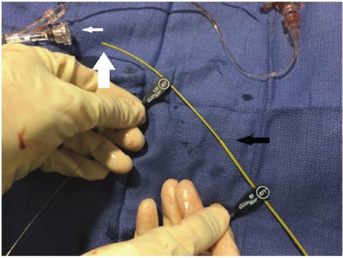 #GuideExtensionTelescoping technique In extreme cases of #CoronaryCalcifications where 1 #GuideExtension is not enough, one of the ways to push support safely to a whole different level is to ADD another #GuideExtensionCatheter @adityadoc1 @evandrofilhobr @timir_paul