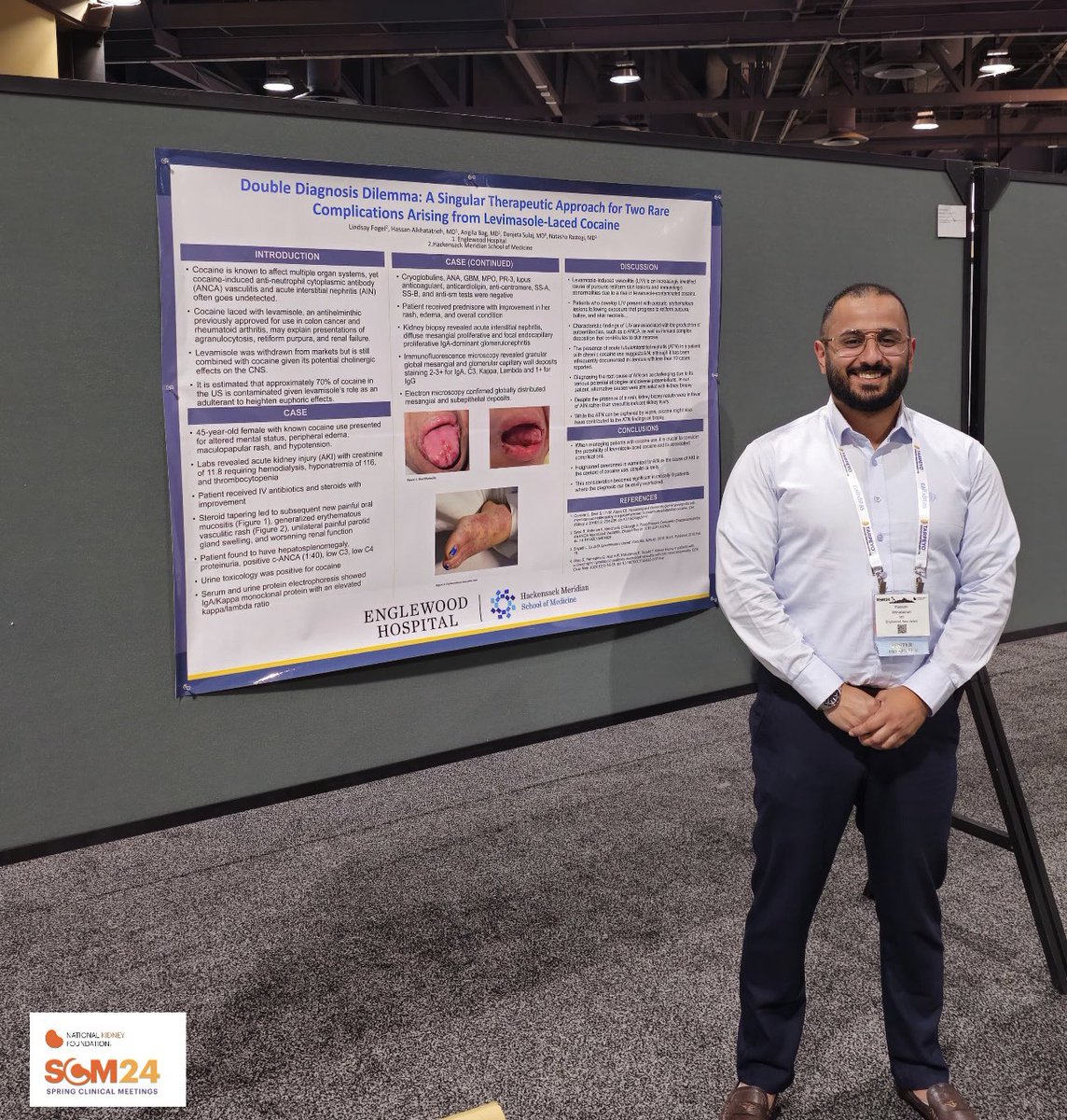 What an exciting week! First up, Hassan (PGY3 Chief) presented his poster on an interesting clinical encounter at the National Kidney Foundation’s (@nkf) Spring Clinical Meeting in Long Beach, CA! Stellar work! 👏 #NKFSCM #NephMadness #MedEd #MedTwitter #Research #IMRes