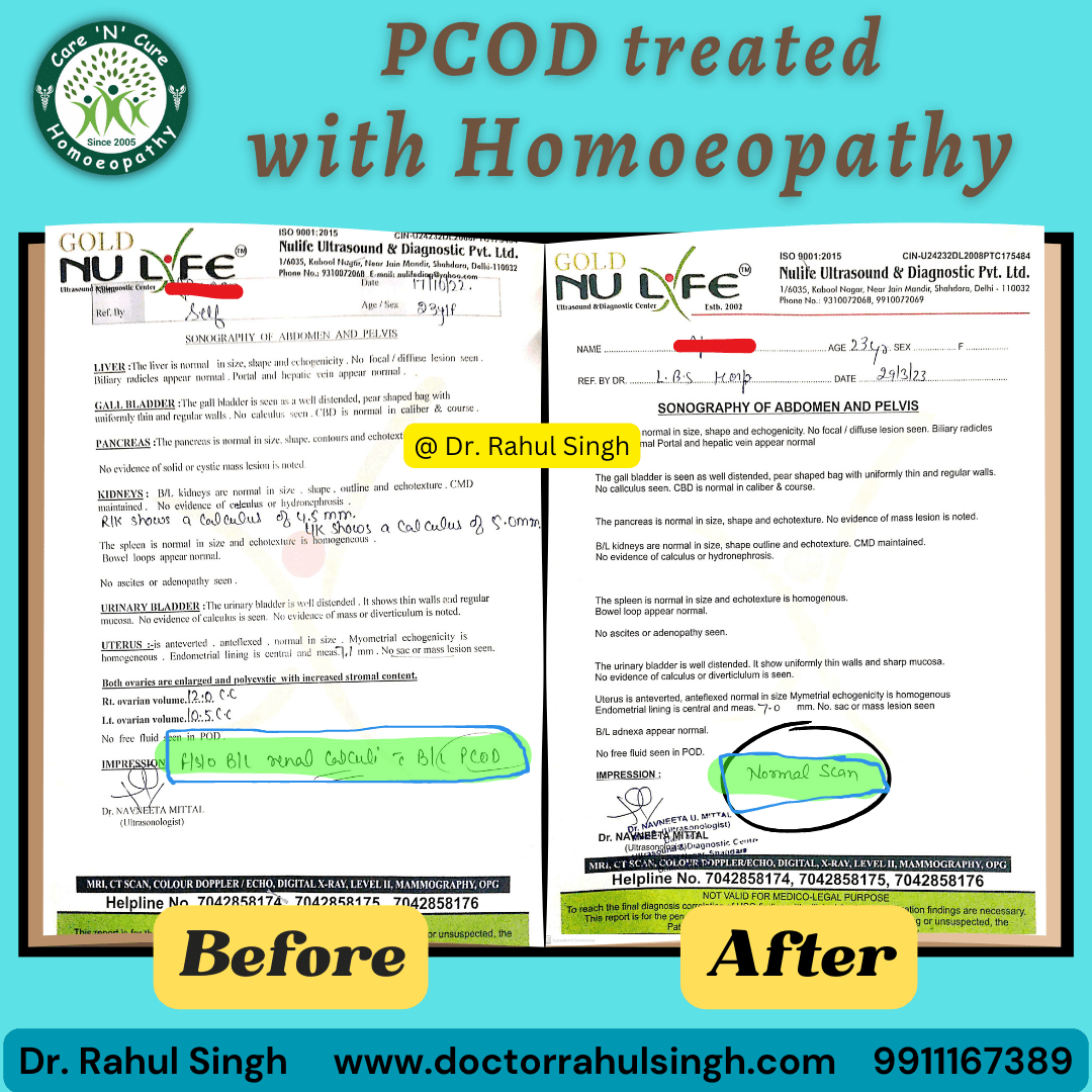 singh_rahul29's tweet photo. 🎉 SUCCESS STORY ALERT! 🎉

Bilateral kidney stones with B/L PCOD cured by Homoeopathy medicines 👍

#PCOD #PCOS #successstory #beforeandafter #transformation
#homoeopathyworks #kidneystones #renalcalculi
#drsinghhomoeopath #DrRahul #drrahulsinghhomoeopath https://t.co/4bTch4ile2