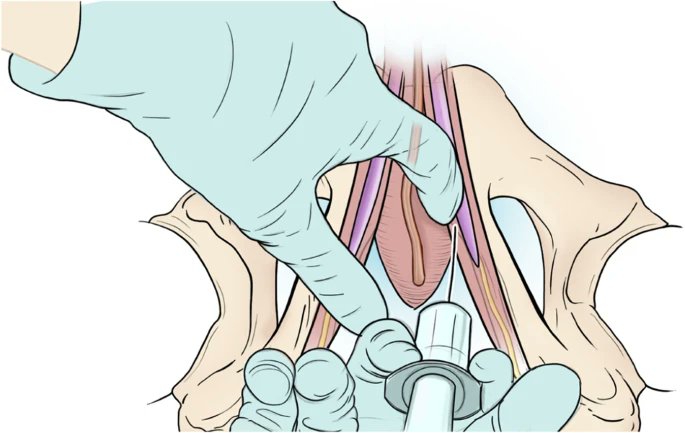 IJIR: Your Sexual Medicine Journal (@yoursexmedjour) on Twitter photo Pudendal nerve block decreases #narcotic requirements and time spent in post-anesthesia care units in patients undergoing primary inflatable #penileprosthesis implantation👉 rdcu.be/dIh4Y
<a href="/MikeZhu4/">Mike Zhu</a> <a href="/KLabagnara/">Kevin Labagnara</a> <a href="/JustinLoloi/">Justin Loloi, MD</a> <a href="/Mustufa_Babar/">Mustufa Babar</a> <a href="/ari_bernstein/">Ari Bernstein, M.D.</a> <a href="/MeenaDavuluri/">Meena Davuluri, MD, MPH</a> Pudendal nerve block decreases #narcotic requirements and time spent in post-anesthesia care units in patients undergoing primary inflatable #penileprosthesis implantation👉 rdcu.be/dIh4Y
<a href="/MikeZhu4/">Mike Zhu</a> <a href="/KLabagnara/">Kevin Labagnara</a> <a href="/JustinLoloi/">Justin Loloi, MD</a> <a href="/Mustufa_Babar/">Mustufa Babar</a> <a href="/ari_bernstein/">Ari Bernstein, M.D.</a> <a href="/MeenaDavuluri/">Meena Davuluri, MD, MPH</a>
