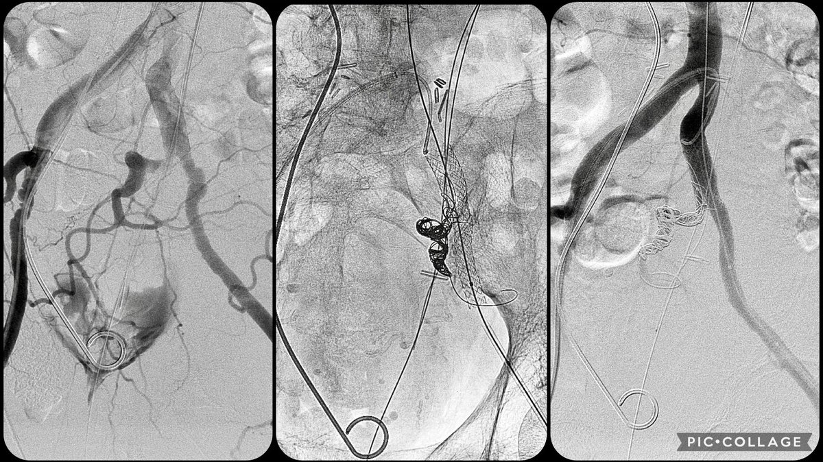 Covered stent assisted coiling of internal iliac artery for uretero-arterial fistula at the bifurcation of iliacs. Telescoping funnel technique for stent graft in the iliacs to prevent endoleak. #VIR #EndoVascular #EmergenciesInAngiosuite @SIRspecialists @SIRRFS @SIR_ECS