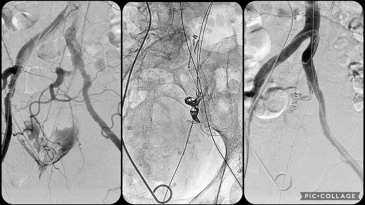 πππ ππ¨π π. πΌππͺππ, ππΏ (@iradrock) on Twitter photo Covered stent assisted coiling of internal iliac artery for uretero-arterial fistula at the bifurcation of iliacs. Telescoping funnel technique for stent graft in the iliacs to prevent endoleak. #VIR #EndoVascular #EmergenciesInAngiosuite <a href="/SIRspecialists/">Society of Interventional Radiology</a> <a href="/SIRRFS/">SIR RFS</a> <a href="/SIR_ECS/">SIR ECS</a> Covered stent assisted coiling of internal iliac artery for uretero-arterial fistula at the bifurcation of iliacs. Telescoping funnel technique for stent graft in the iliacs to prevent endoleak. #VIR #EndoVascular #EmergenciesInAngiosuite <a href="/SIRspecialists/">Society of Interventional Radiology</a> <a href="/SIRRFS/">SIR RFS</a> <a href="/SIR_ECS/">SIR ECS</a>
