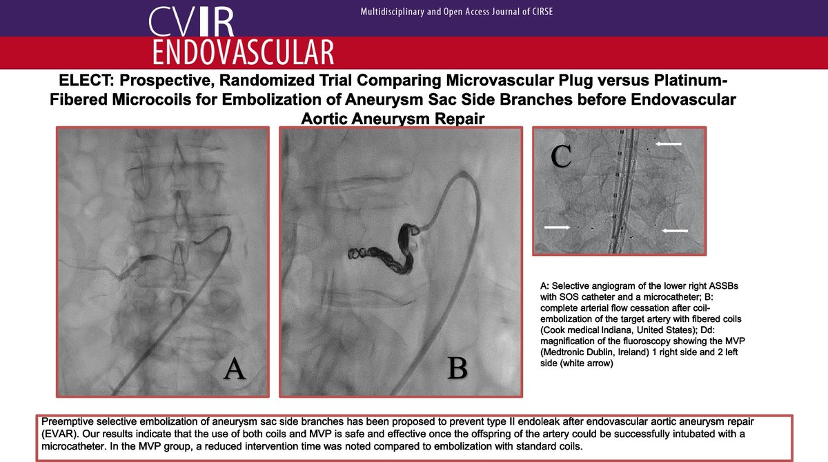 This study aimed to explore if an embolization strategy using microvascular plugs reduces intervention time and radiation dose compared to platinum-fibered microcoils Read the full article for more on effectiveness in occluding the treated artery: cvirendovasc.springeropen.com/articles/10.11… #IRad