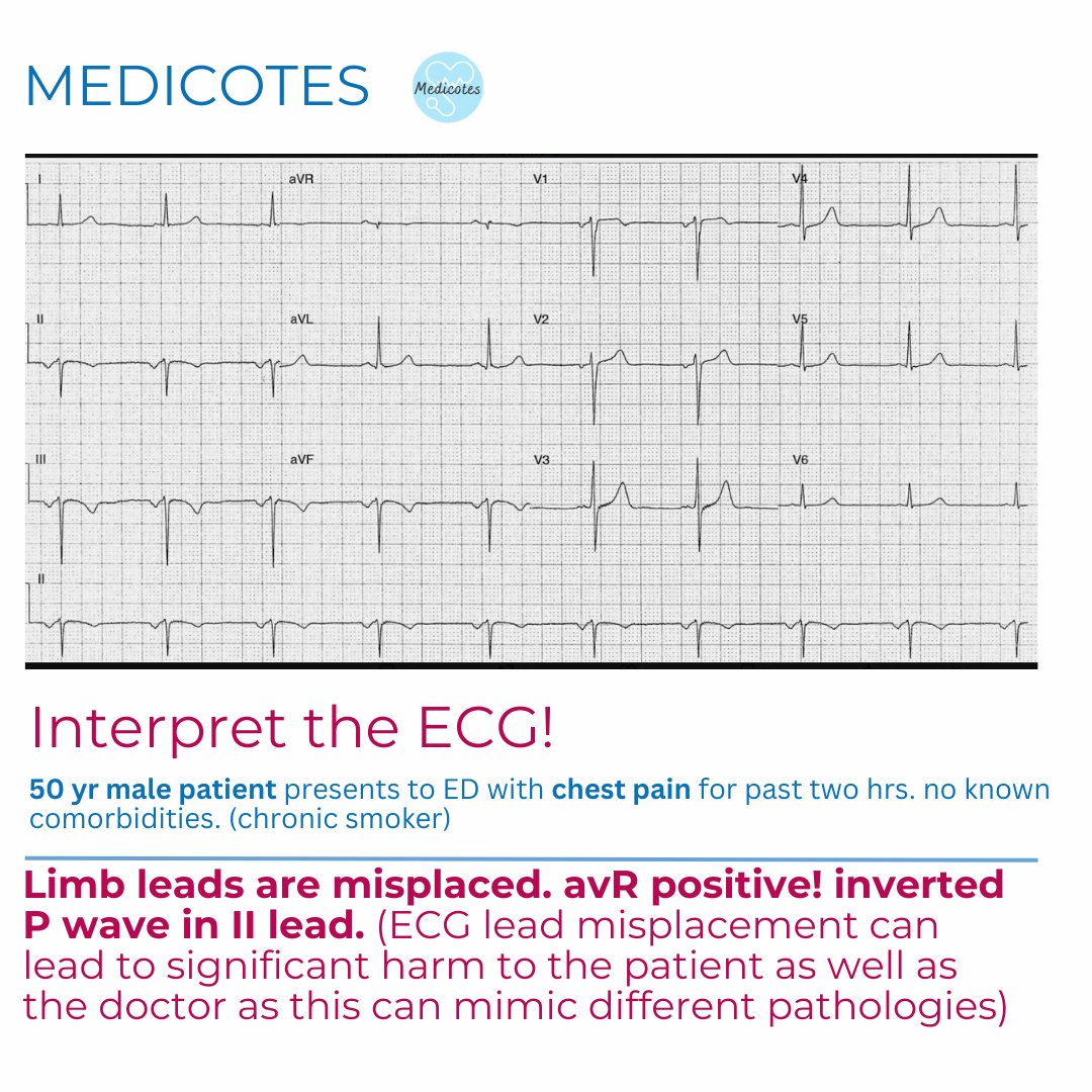 Learn to differentiate between Dextrocardia v/s Limb lead misplacement.

Careful Interpretation of ECG is very important.

#medicotes #medi_cotes #MedEd #medicalmcq #questformedicine #medicalnotes #physicianassociate #ecg #leadmisplacement #dextrocardia #myocardialinfarct