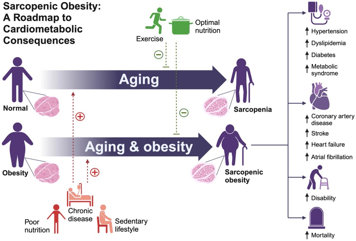 Sarcopenic Obesity and Cardiovascular Disease: An Overlooked but High-Risk Syndrome… link.springer.com/article/10.100…