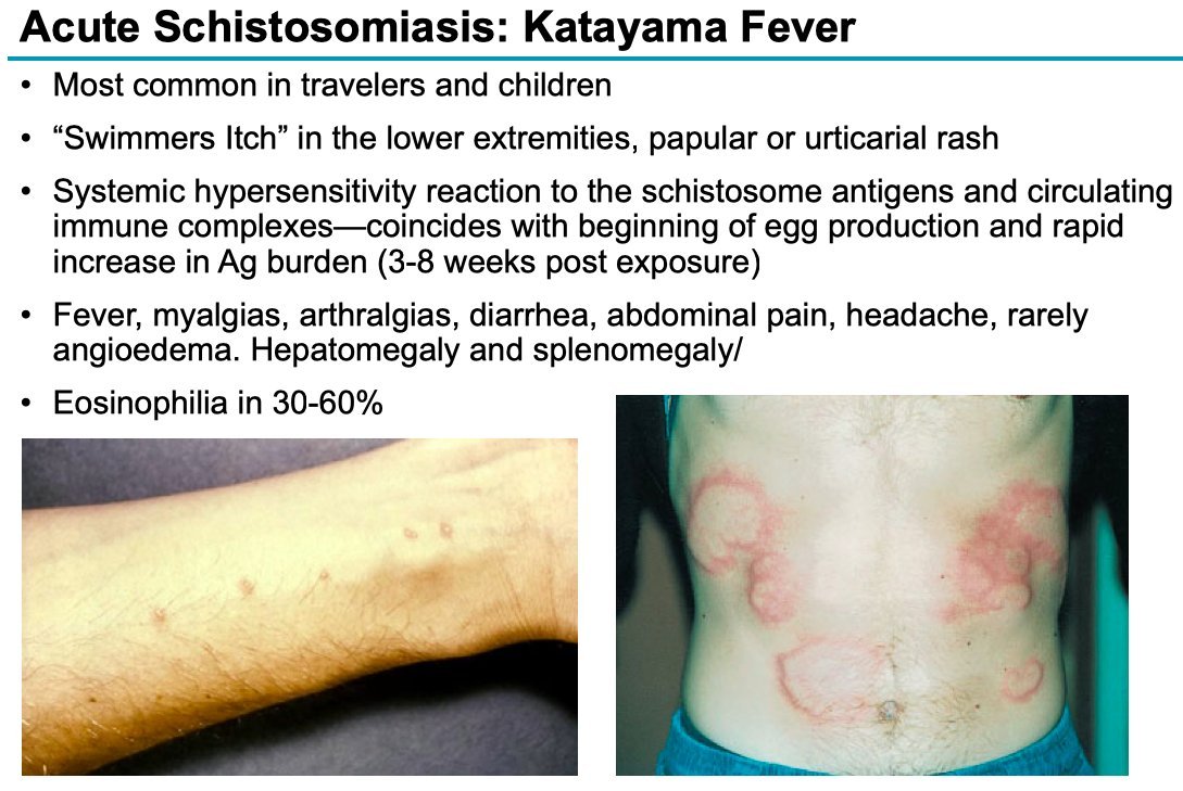 @drkeithsiau Suspected acute schistosomiasis (Katayama syndrome or bilharzia)

DDx: infectious mononucleosis, HLH, TSS, leptospirosis, SLE

<Image source: @BrighamMedRes via @grepmeded, tinyurl.com/2hr27c3s>