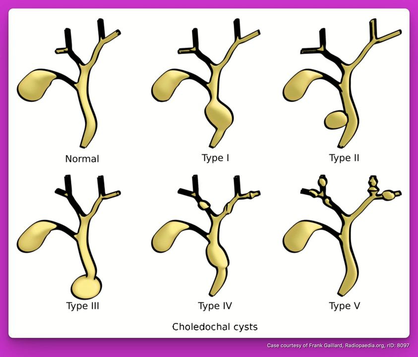Choledochal Cyst Types Choledochal cysts represent congenital cystic dilatations of the biliary tree. Diagnosis relies on the exclusion of other conditions (e.g. tumor, gallstone, inflammation) as a cause of biliary duct dilatation.