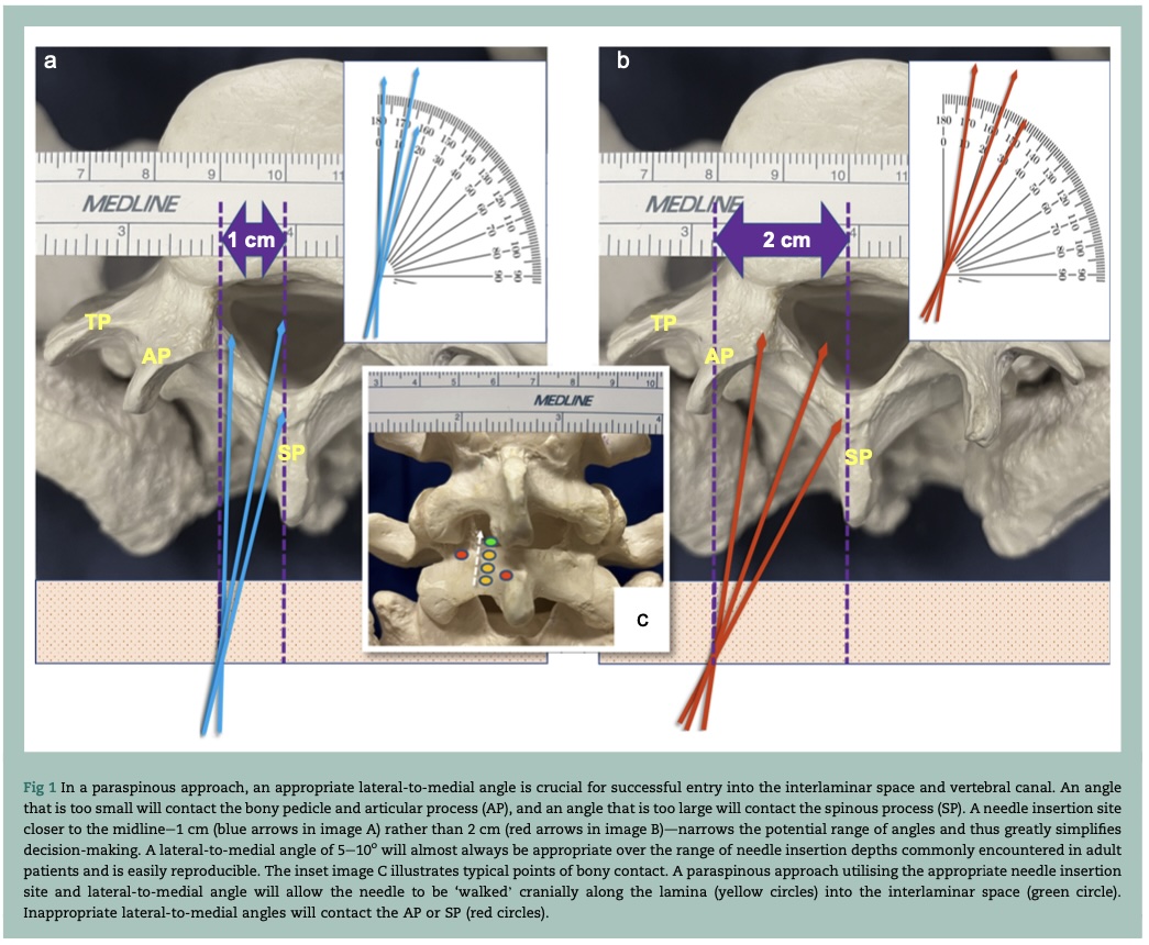 #BJAEd - The difficult #spinal anaesthetic: the key to success? Dr Poots &amp; Prof Chin elegantly describe the #paraspinous approach, why it could work well, and how to do it. An article which could change your every day practice. Read the full article at: bjaed.org/article/S2058-…