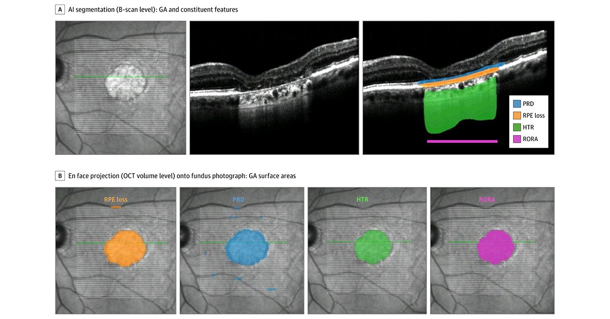 Most viewed in the last 7 days from @JAMAophth: What is the association between intravitreal pegcetacoplan and consensus spectral domain optical coherence tomography features of geographic atrophy? ja.ma/3V4ZNyf