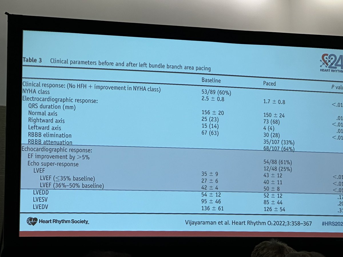 simovicst's tweet photo. @Marek_Jastrz_EP Role of LBBAP in pts with RBBB

-We can resynchronize LV in patients with RBBB (if LBB disease is present - atypical RBBB)
-Direct activation of the RV septum is the key for resynchronization in RBBB (non-selective LBBAP)
-Improvement in septal movement with LBBAP 

#HRS2024