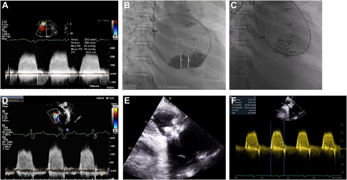 📑Transcatheter Melody valve – unconventional solution to bioprosthetic tricuspid valve dysfunction after pediatric heart transplant. #MelodyValve #TricuspidRegurgitation #PediatricHeartTransplant Check out the case today🔎 ➡️doi.org/10.1016/j.jsca…