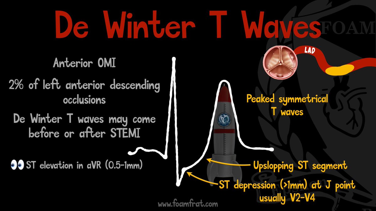 🔴De Winter T Wave ECG Pattern ✅ 2% of LAD occlusions ✅ De Winter T waves may come before or after STEMI ✅Look for 1) Upsloping ST elevation in aVR (>= 1 mm) 2)ST depression (>1mm) at J point usually V2-V4 3)Tall , symmetrical T waves in precordial leads