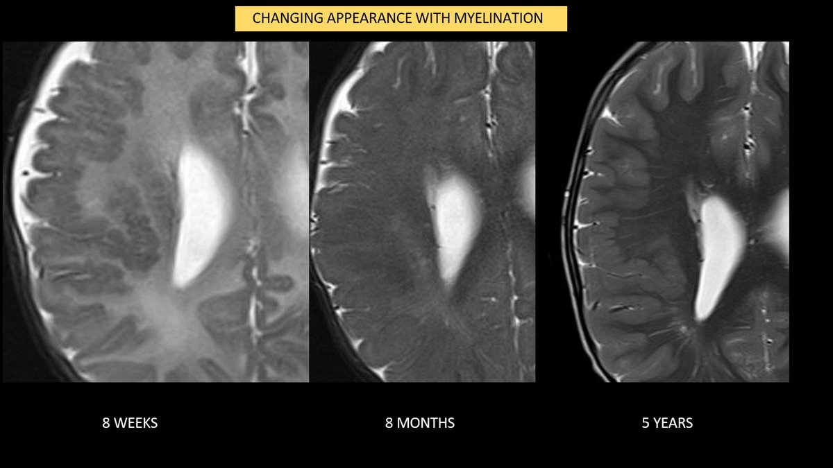 Dr. Sudhakar expresses the importance of becoming familiar with appearance of the normal grey and white matter during ongoing myelination which may cause malformations of cortical development to become more or less identifiable at any given age. 
#IPNTN #pedineurorad #neurorad