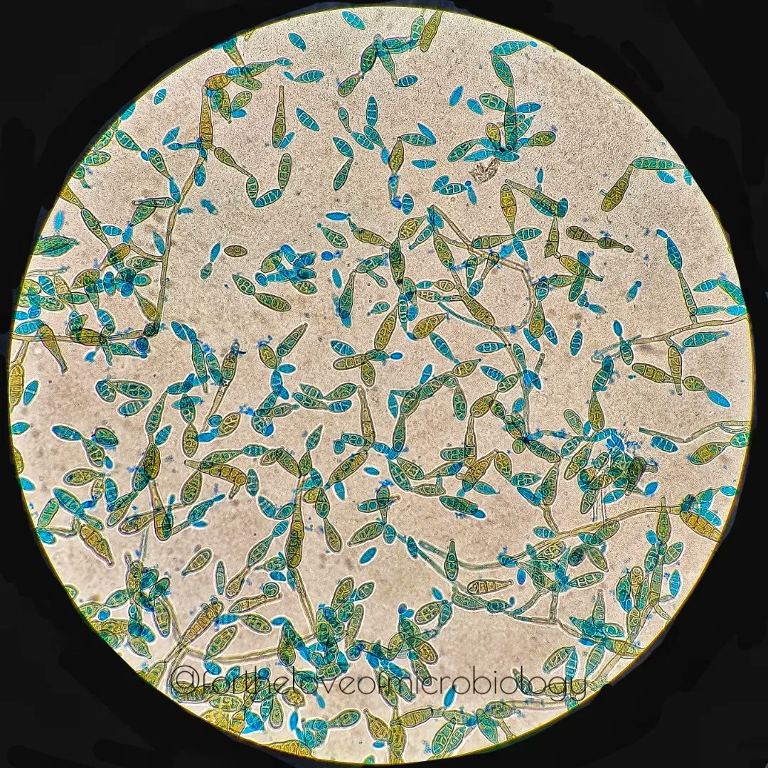 Alternaria LCB prep on microscopy

#Fortheloveofmicrobiology #clinicalmicrobiology
#mmidsp #microrounds #IDpath #ASMClinMicro #MicroTwitter #STEM #WomeninMicrobiology #medtwitter #ClinMicro #microbiologypakistan #PathBugs