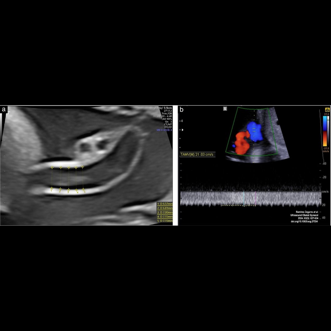 Ramirez Zegarra et al. demonstrate an association between reduced umbilical vein flow close to term, severely stunted fetal growth and adverse perinatal outcome in a cohort of low-risk pregnant women. Read open-access article in May #UOGJournal issue: bit.ly/4afhLCx