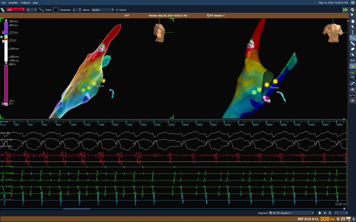 10 yrs old, VSD closure. Double tachycardia (AVNRT + AT ?SVC cannula site). Note CS deep (hence CS signals).