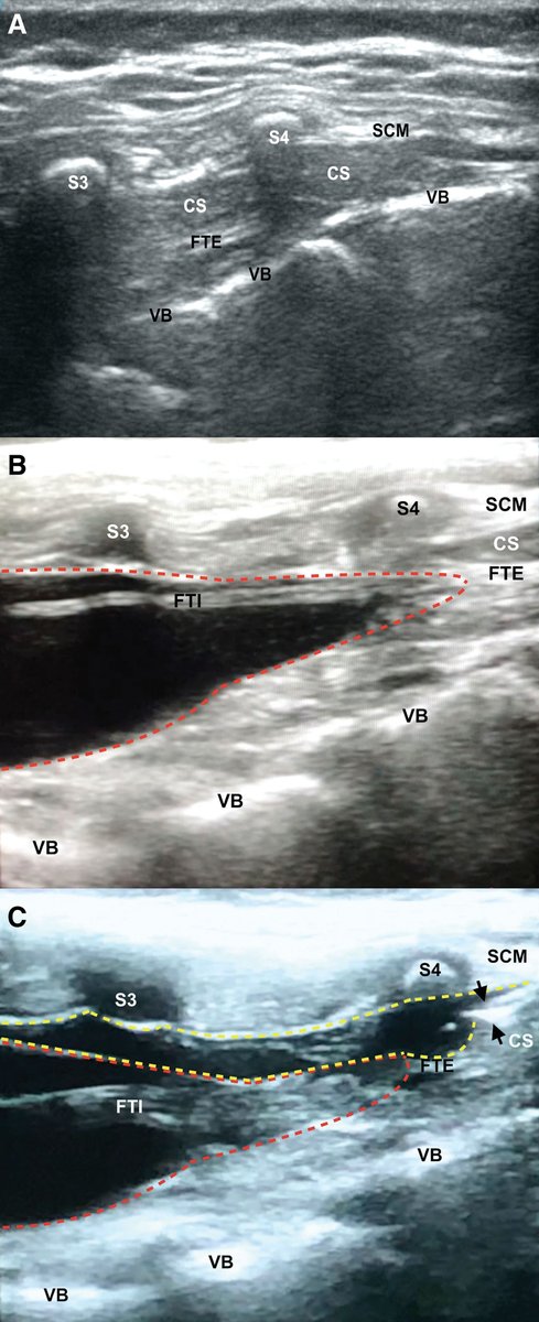 Images in #Anesthesiology - Tethered Spinal Cord Syndrome Discovered during Ultrasound-guided Caudal Block 📷 ow.ly/fe3t50RKq8X