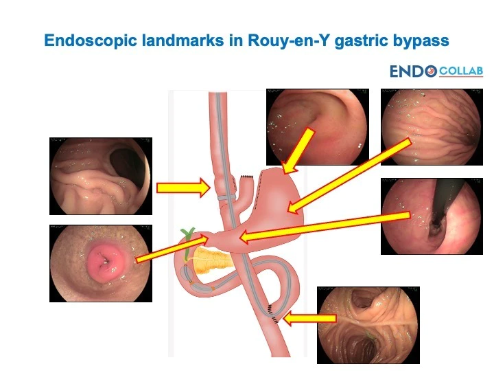 Endoscopic landmarks in Roux-en-Y gastric bypass RYGB is becoming a common operation to treat obesity. We are seeing more and more patients with RYGB.