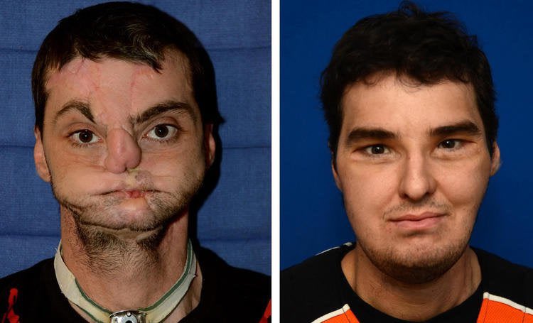 Richard Norris, who was disfigured by an accidental self-inflicted gunshot, lived reclusively for 15 years even resorting to wearing a mask to hide his own face. 

He accidentally shot himself in the face aged 22 in 1997, blowing off his nose, cheekbones, lips, teeth and jaw.