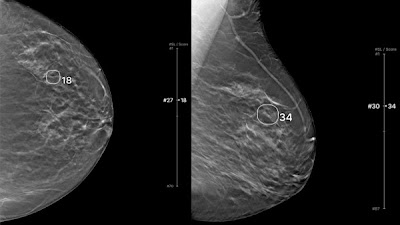 #AI model showed higher diagnostic accuracy than radiologists in #BreastCancer detection doi.org/10.1148/ryai.2… @yonsei_u #cancer #tomosynthesis #ML