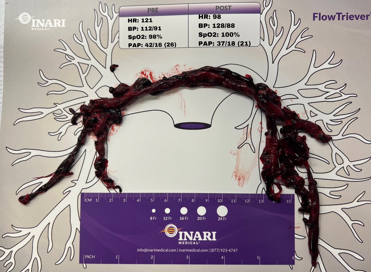 When the ECMO team on standby in the room GASP with the first clot haul, vitals return to normal 5 min later, and the CT surgeon says “looks like you don’t need me anymore” you know you’re doing something right. This right heart was on the brink of failure. Another life saved!