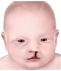 Cleft palate is often associated with which other condition?

A. Diabetes.
B. Congenital heart defects.
C. Down syndrome.
D. Asthma.
#medx
#medEd
#MedTwitter #medicine
@IhabFathiSulima 
@BrownJHM