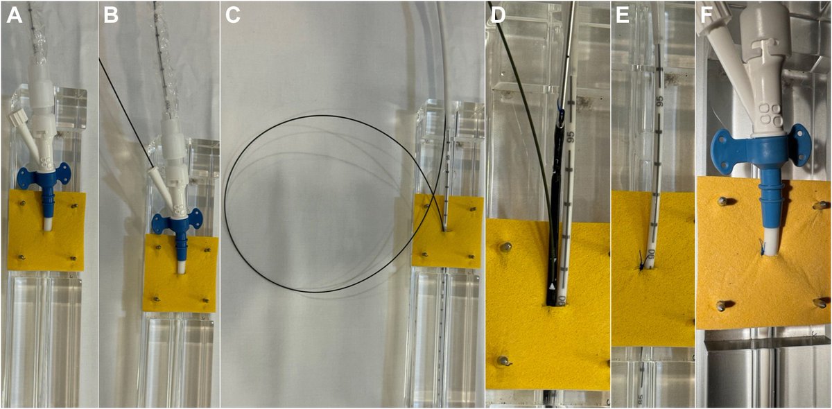The Sideclose technique for #Impella access site bleeding new in <a href="/MyJSCAI/">MyJSCAI</a>. Stop the bleeding, keep the Impella! @jason_wollmuth #MCS
doi.org/10.1016/j.jsca…