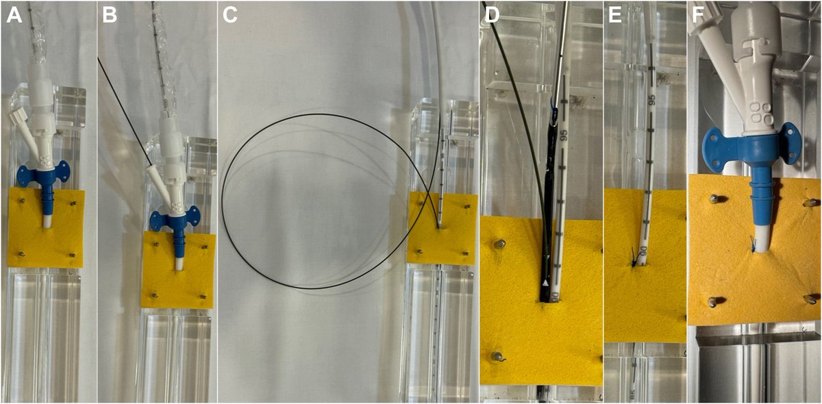 The Sideclose technique for #Impella access site bleeding new in @MyJSCAI. Stop the bleeding, keep the Impella! @jason_wollmuth #MCS doi.org/10.1016/j.jsca…