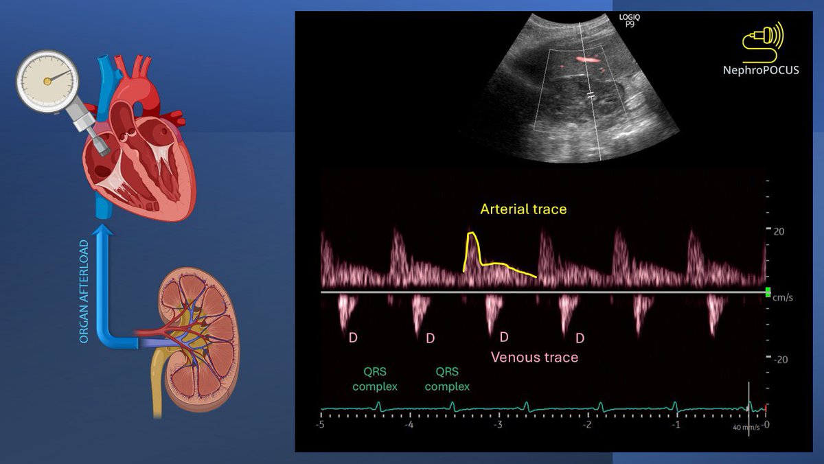 Weekend #POCUS Classic Monophasic intrarenal waveform #VExUS #MedEd