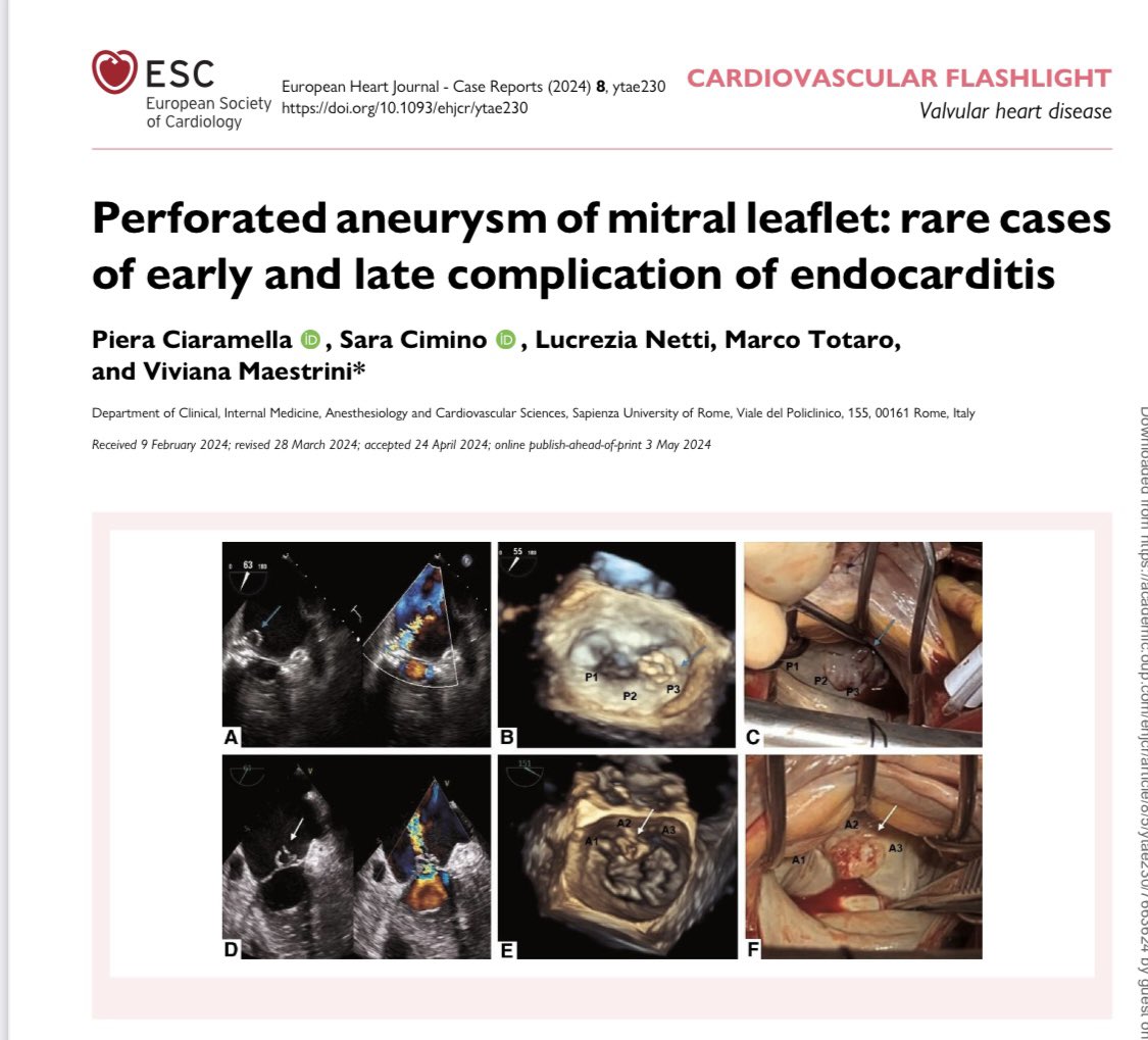 Perforated aneurism of mitral leaflet#EHJ-CR

pubmed.ncbi.nlm.nih.gov/38751902/