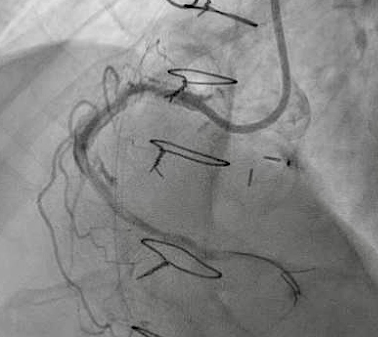 Entrapped Rota 💎 Burr in calcified RCA CTO (after temporizing SVG PCI and native RCA true-lumen wire crossing). Solution? Subintimal wire and balloon 🎈 to “free” the Burr and facilitate removal. Re-do PCI deferred for another day…