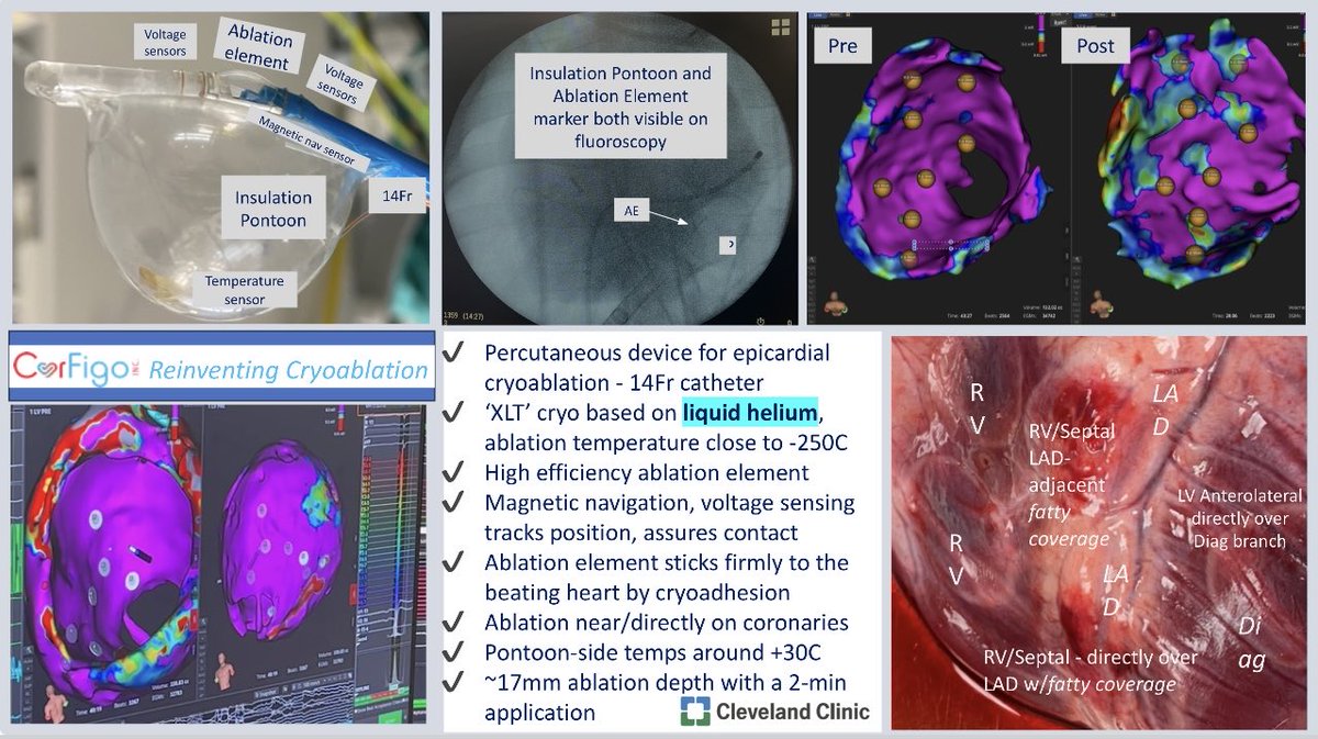 Great work by ⁦@ioanliuba⁩ in collaboration with ⁦⁦@corfigo⁩ with a novel XLT liquid helium cryoablation epicardial device