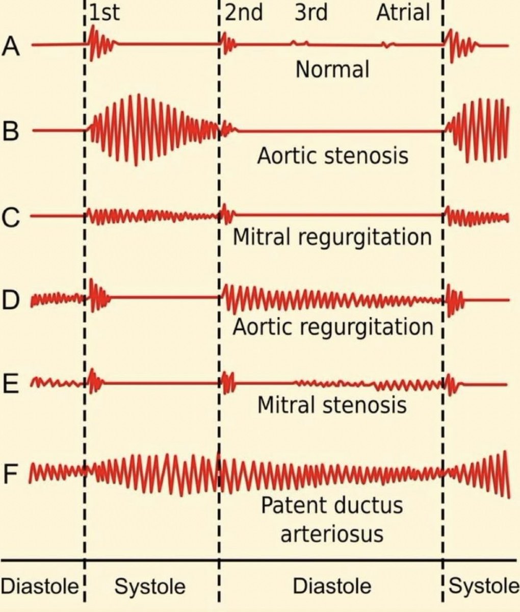 Murmurs