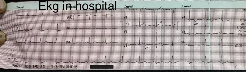 Two contrasting EKGs of a patient rushed in with chest pain who received a swift cocktail of aspirin, clopidogrel, and morphine from the EMTs. Upon arrival, his pain eased, prompting paramedics to ask: did aspirin/clopidogrel work their magic . What would you say? #cardiotwitter