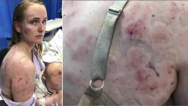 Fiona Simpson, une mère australienne a mit sa vie en jeu en faisant barrage avec son propre corps pour protéger sa fille de 4 mois lors d’une tempête de grêle.
