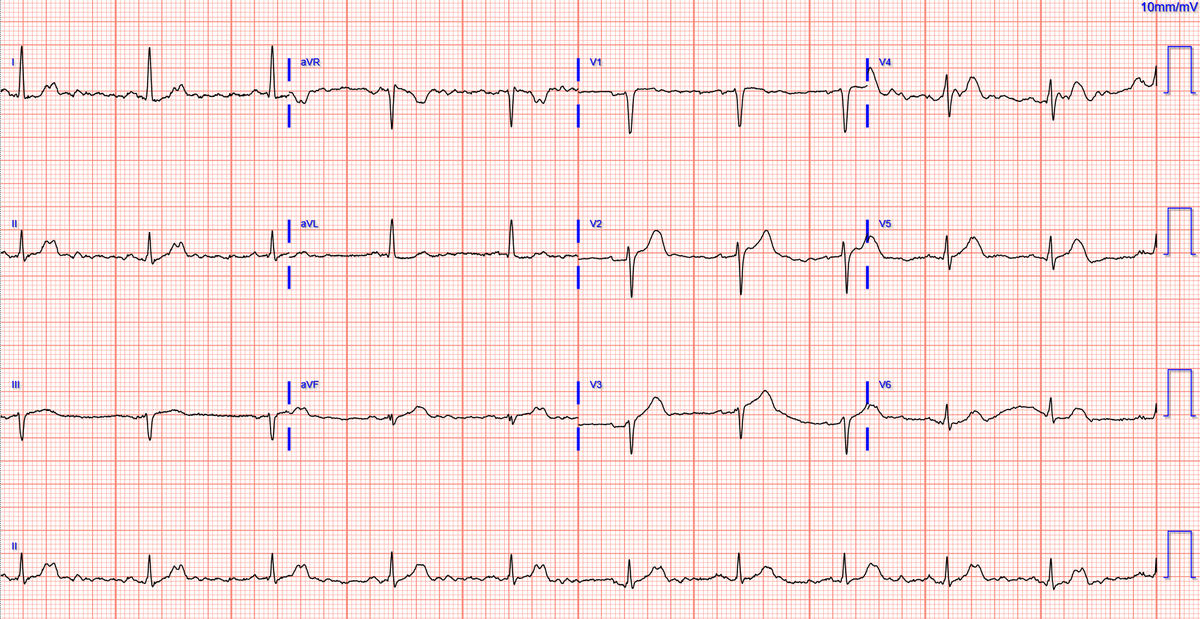 Early repol or anterior OMI? hqmeded-ecg.blogspot.com/2024/05/early-… @PendellM
