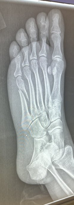 looks like mommy is staying put for 6 weeks at least - non weight bearing until July 😔 https://t.co/<a href="/tag/timetoski"class="tags"><span>#timetoski</span></a><a href="/tag/naturebums"class="tags"><span>#naturebums</span></a>