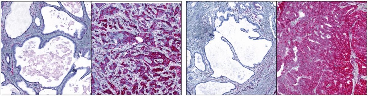 A research team from @tudresden_de showed that the glutamine metabolism key 🗝️ protein GLS1 is a potential target in docetaxel-resistant #mCRPC cells with a #mesenchymal phenotype and a biomarker of CRPC aggressiveness. 👉 go.nature.com/3V3RkeU