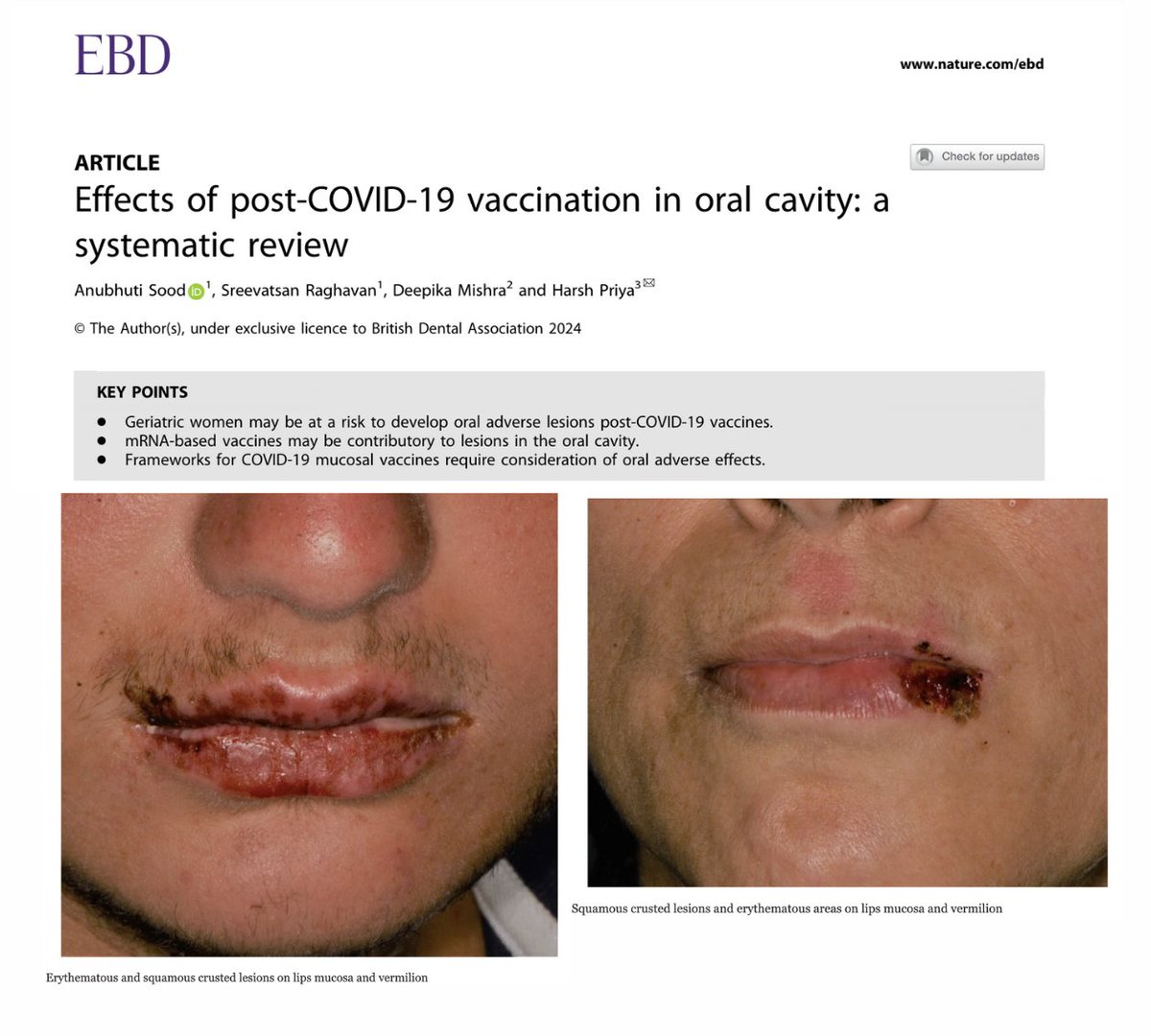 NEW STUDY - COVID-19 mRNA injections linked to various types of oral lesions a few days following inoculation, likely due to immune dysregulation. The diagnosis of the lesions included erythema multiforme minor, lichen planus, burning mouth syndrome, herpes trigeminal