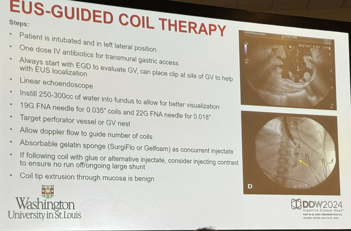 Steps to EUS-guided Coil Therapy for Gastric Varices ▪️Intubate ▪️One dose of ABx ▪️Start with EGD ▪️Then linear EUS ▪️Instill 250-300cc water in fundus ▪️19g for 0.035” & 22g for 0.018” coils ▪️Target perforater ▪️Doppler to guide coil # ▪️Absorbable gelatin sponge #DDW2024