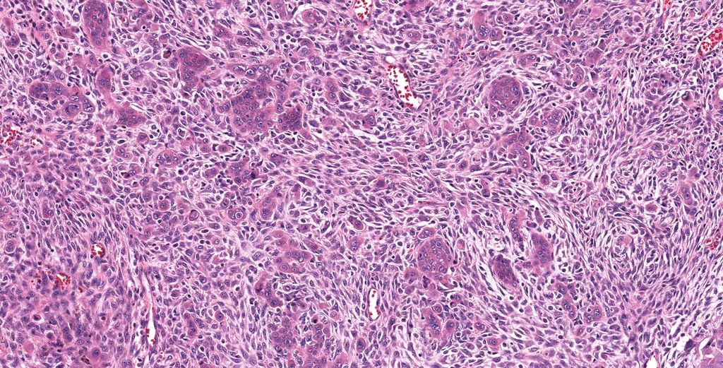 JMGardnerMD's tweet photo. You don't see this every day! 60 yo man with shoulder lesion. Your diagnosis?
WSI digital slide: https://t.co/xkkNSrO2cF 
Answer &amp; video: https://t.co/SlZQXpZveU
#pathology #pathologists #pathTwitter #dermpath #dermatology #dermatologia #dermtwitter https://t.co/uFnk7I4lIt