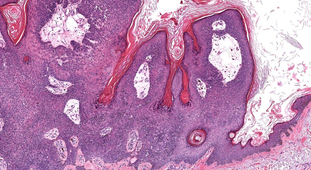 JMGardnerMD's tweet photo. You don't see this every day! 60 yo man with shoulder lesion. Your diagnosis?
WSI digital slide: https://t.co/xkkNSrO2cF 
Answer &amp; video: https://t.co/SlZQXpZveU
#pathology #pathologists #pathTwitter #dermpath #dermatology #dermatologia #dermtwitter https://t.co/uFnk7I4lIt