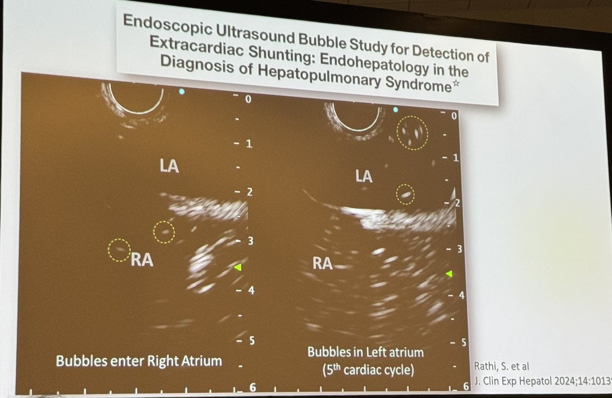 EUs Bubble Study for Detection of Extracardiac Shunting: Endohepatology in Diagnosis of Hepatopulmonary Syndrome ▪️Bubbles enter Right Atrium ▪️Bubbles in Left atrium (5th cardiac cycle) Need LARGE bubbles to accomplish this! Not just standard contrast bubbles. #DDW2024