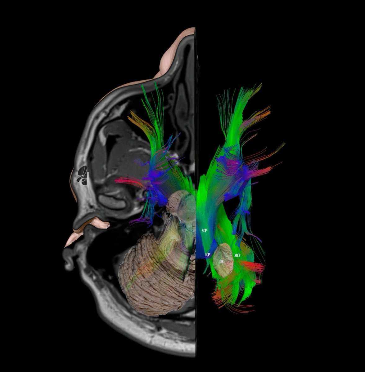 #OnlineFirst: Dentate nucleus: a review and implications for dentatotomy

Check out the full article:
link.springer.com/article/10.100…

#dentatotomy #dentatenucleus #cerebellum #neurosurgery