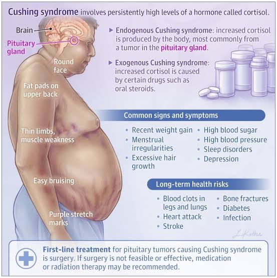 PeterItebimien's tweet photo. @drkeithsiau Cushing syndrome 
Abdominal striae + hypertension
⤴️⤴️⤴️ Cortisol 
Photos @OsmosisMed @JAMA_current https://t.co/b17v320bgY