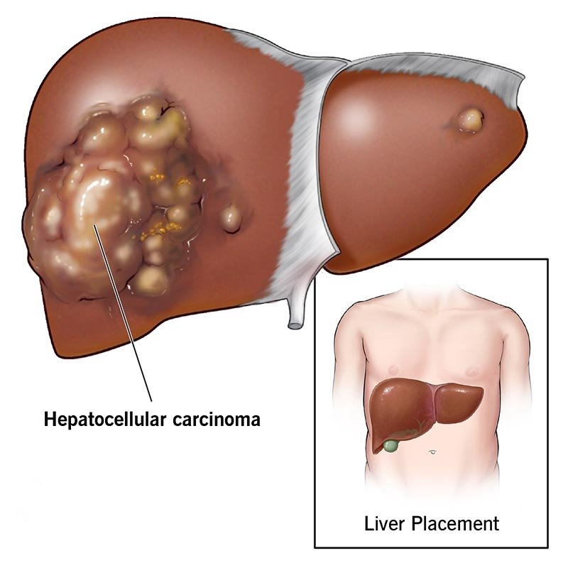 📙𝘾𝙇𝙄𝙉𝙄𝘾𝘼𝙇 𝙌𝙐𝙄𝙕:-

Which of the following clotting factors retains its activity in 
hepatocellular disorder? 

A.  II 
B.  VIII 
C.  IX 
D.  VII

#medx
#medEd
#medtwitter