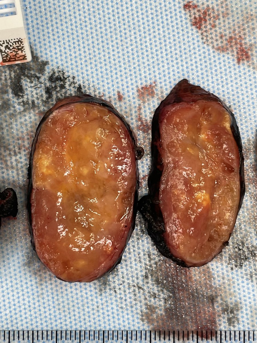 Here’s an interesting case— something I don’t see everyday😳 26F low abdominal/pubic 6 cm. Had a smooth outer border #BSTpath