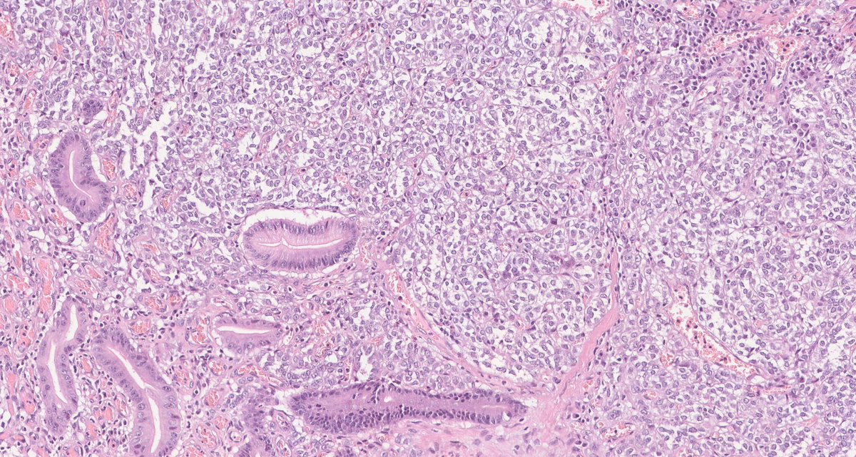 Gastrointestinal neuroectodermal tumor (GNET)/clear cell sarcoma-like tumor of the gastrointestinal tract Credits (WSI): thepathologist.com/exercise-your-… 👧🏼2-4th decade; ♀️ predilection 🔬majority in small intestine 🔬deeply invasive, highly cellular, mostly epithelioid, monomorphic