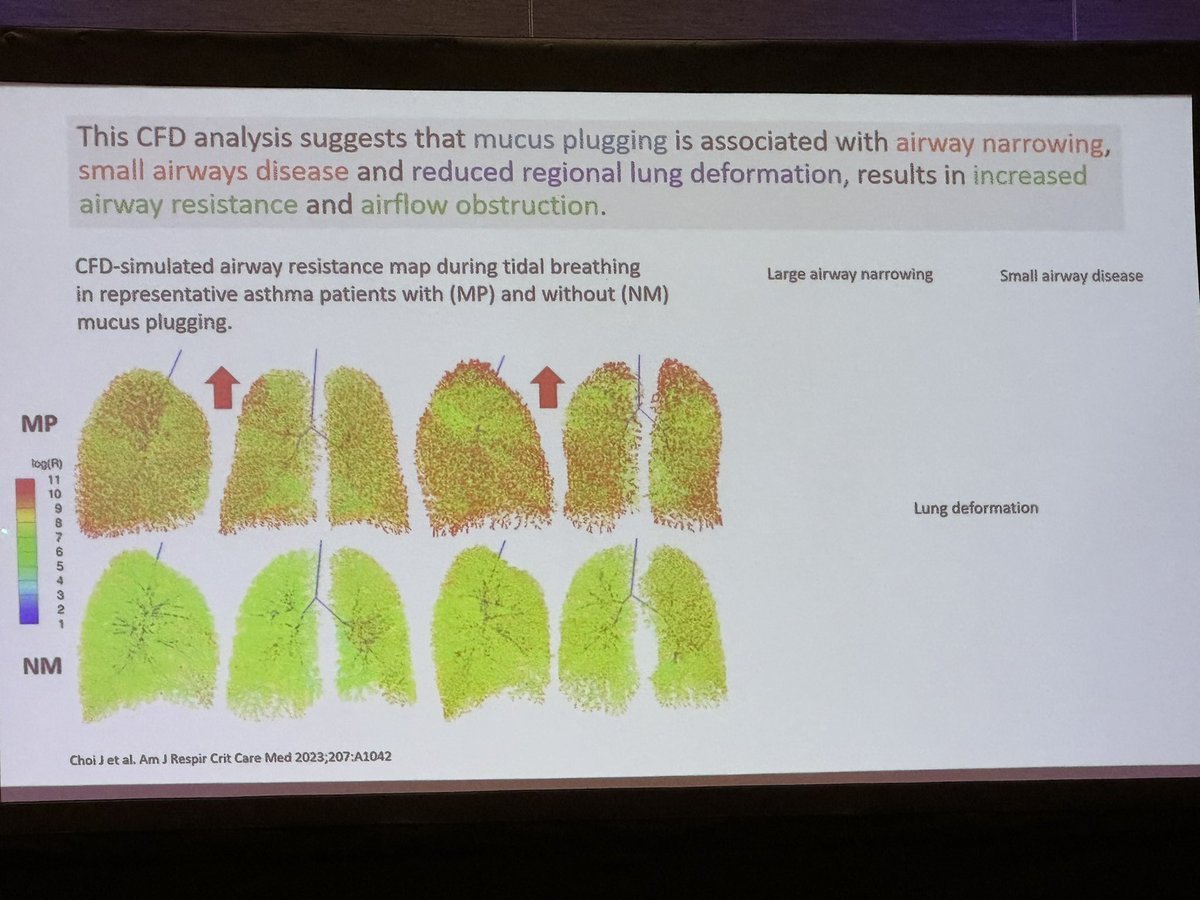 @atsearlycareer @atscommunity @ATS_AII @CCF_PCCM @ClevelandClinic #ATS2023 #ATS2024
Intelectin-1 gene influences mucus plugging in asthma #SARP which increases airway resistance