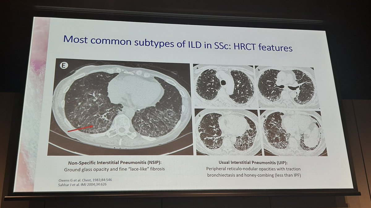 Systemic sclerosis and ILD
-Dr Susanna Proudman 

*scl-70 / anti-topoisomerase worse ILD than others (Centromere/RNApol)
* early onset of disease and diffuse associated higher risk
* high CRP considered more at risk of significant ILD

#ARANZRA24